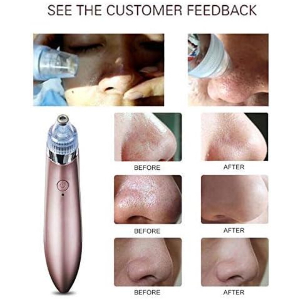 5-in-1 Pore Cleaning Device with USB Rechargeable Technology - Image 4